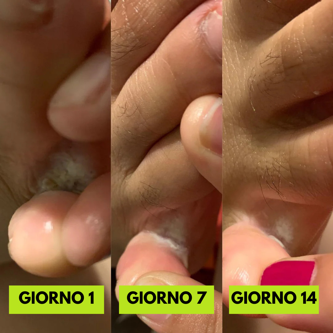Selavie® - Sapone Antimicotico contro il Piede d’Atleta