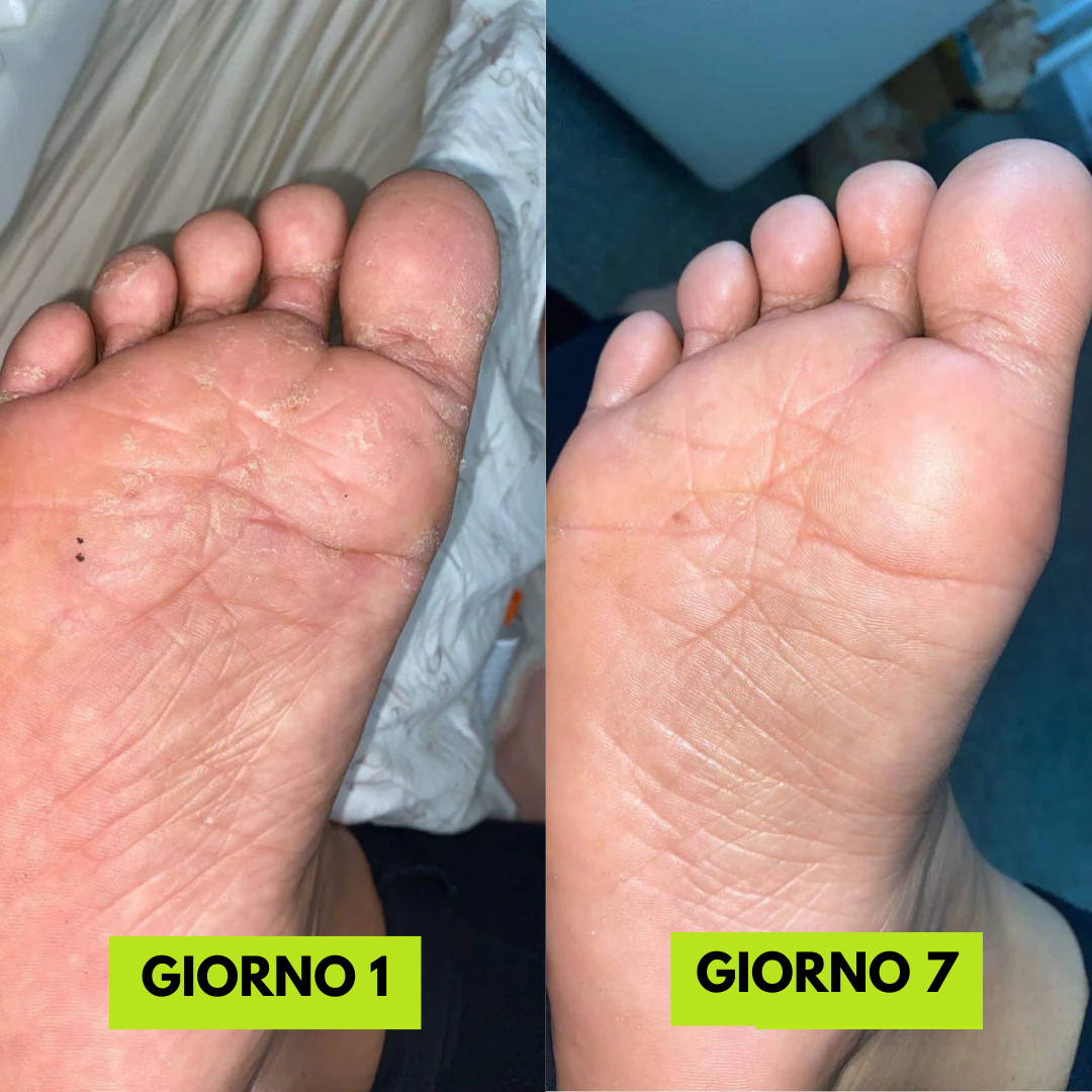 Selavie® - Sapone Antimicotico contro il Piede d’Atleta