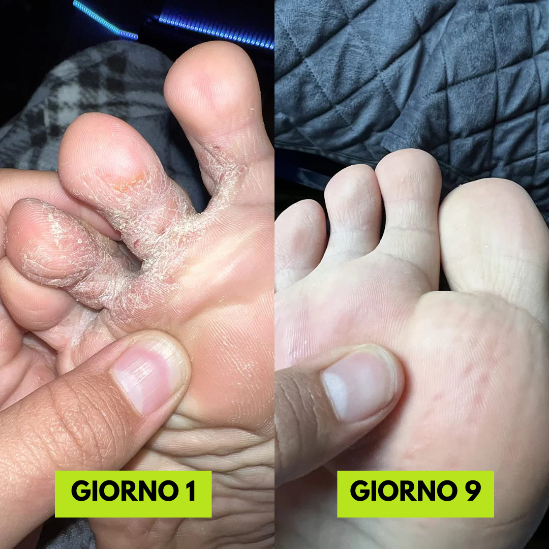 Selavie® - Sapone Antimicotico contro il Piede d’Atleta